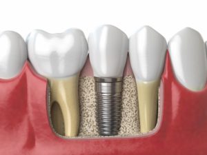 anatomy-of-healthy-teeth-and-tooth-dental-implant-2021-04-02-20-54-01-utc (1)