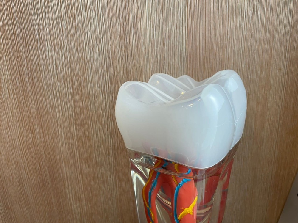 Read more about the article 陶瓷牙是甚麼？可以用金屬取代嗎？