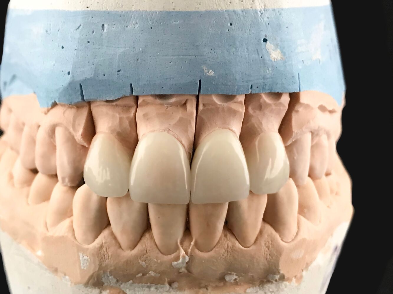 close up of dental prosthesis porcelain teeth in a 2023 08 16 01 07 31 utc 1