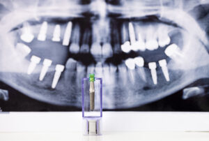 dental implant and x ray picture as background 2023 11 27 05 18 14 utc