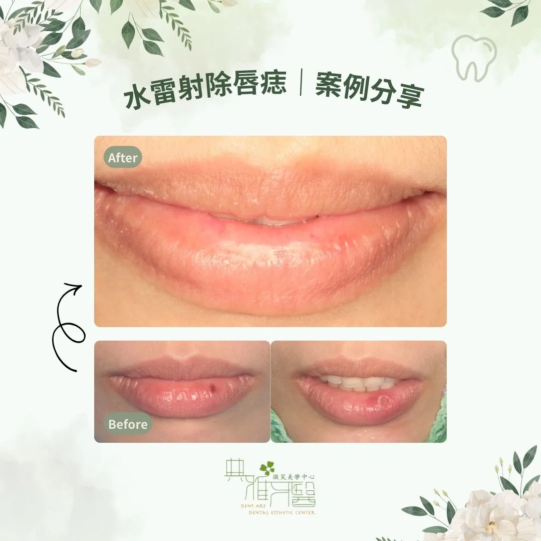 水雷射除唇痣
