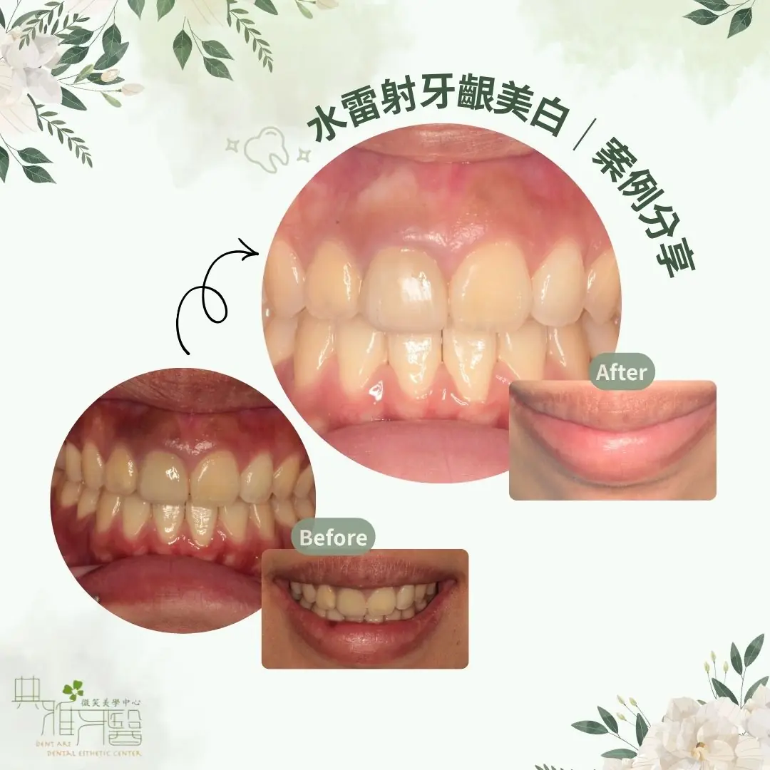 水雷射牙齦美白｜案例分享