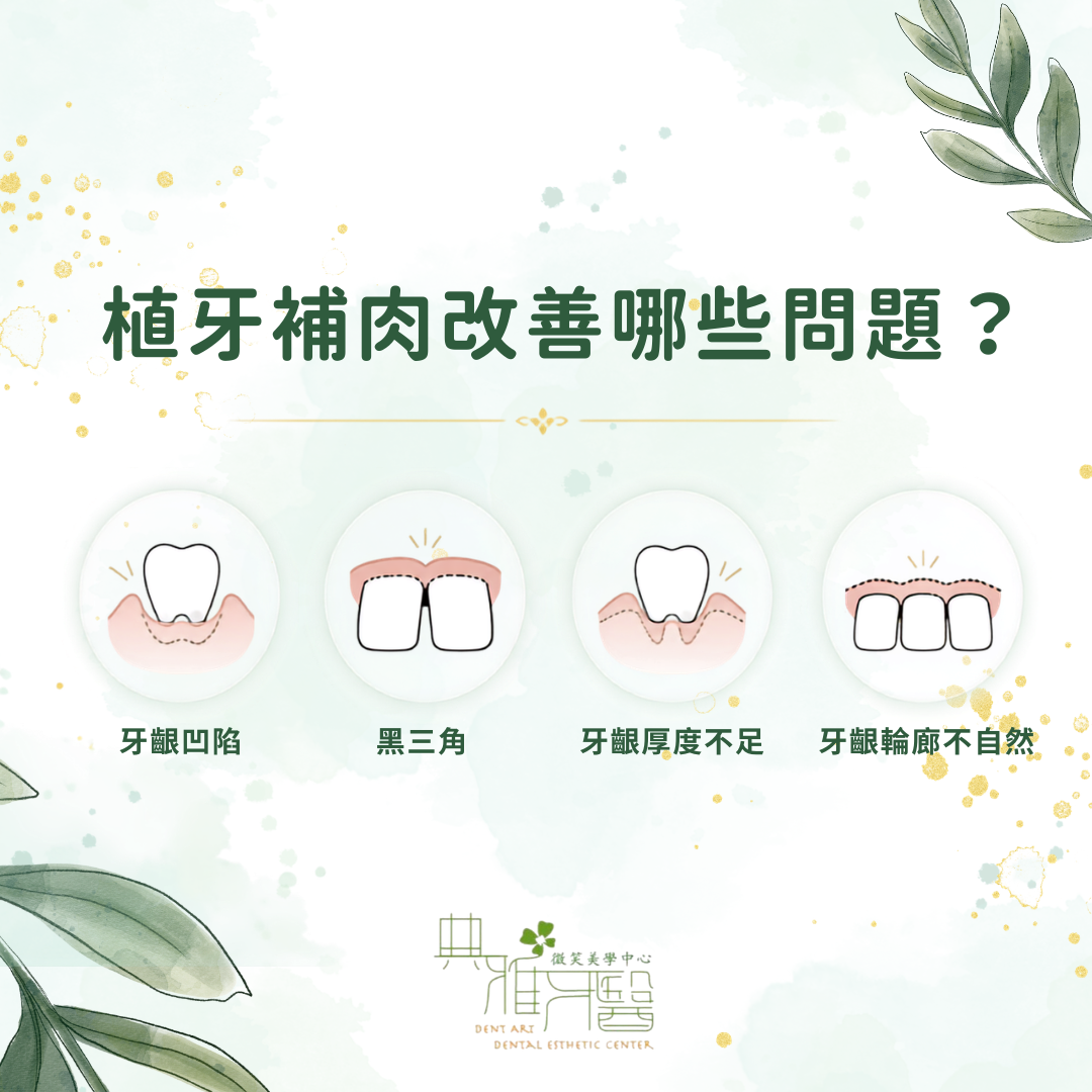 植牙補肉可改善牙齦凹陷、黑三角、牙齦厚度不足與牙齦輪廓不自然