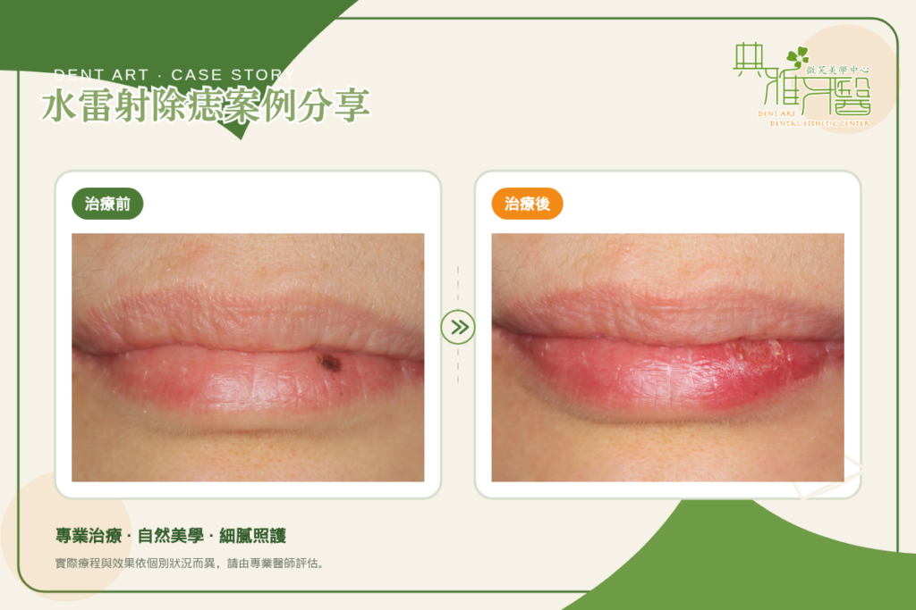 下唇水雷射除痣治療前後對比（典雅牙醫案例）