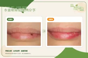 水雷射 2 下唇水雷射除痣治療前後對比(典雅牙醫案例)