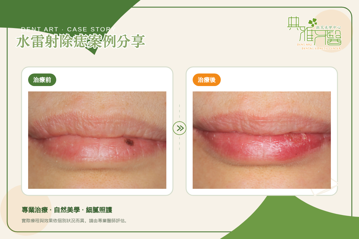 下唇水雷射除痣治療前後對比（典雅牙醫案例）