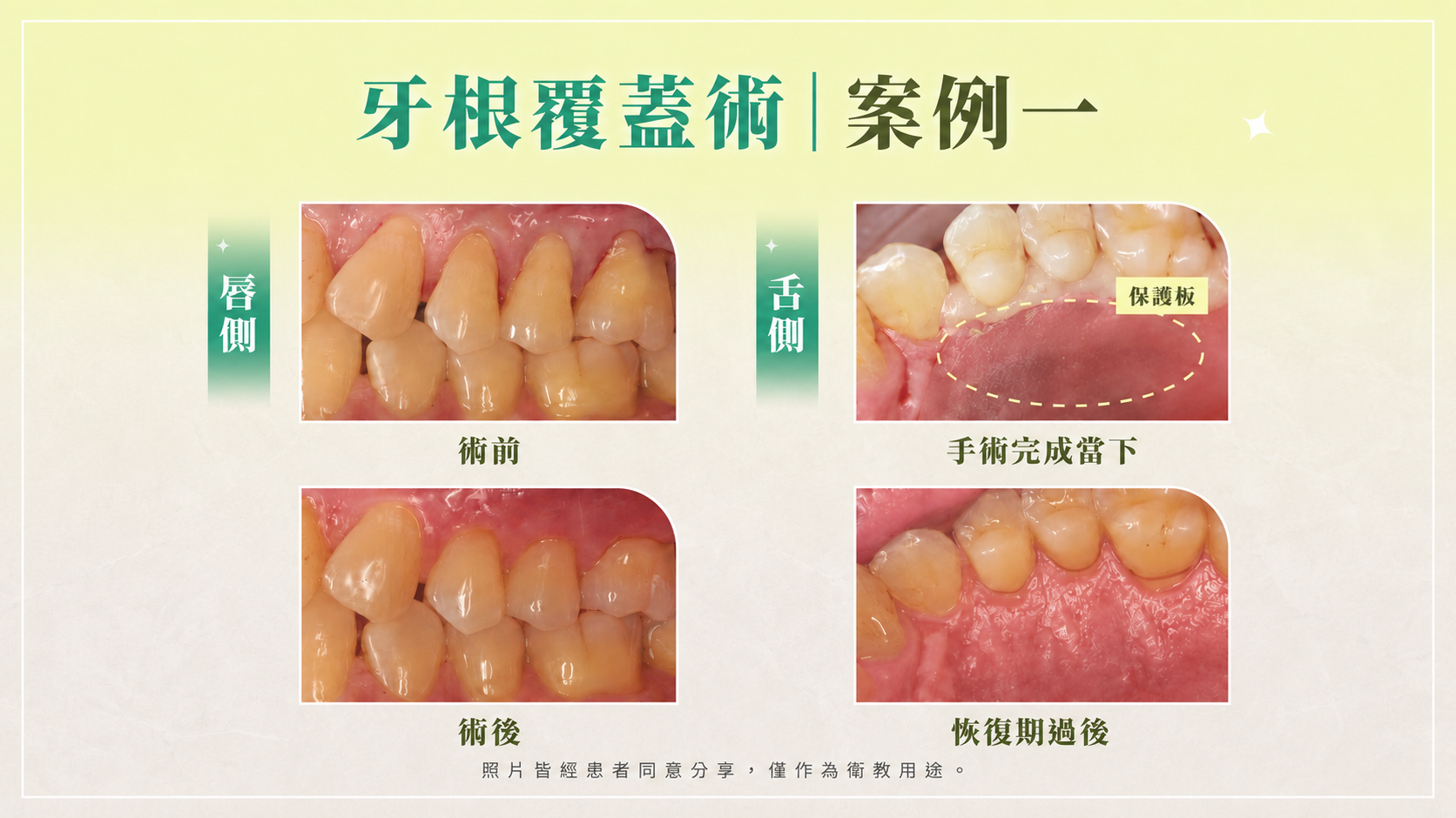 牙根覆蓋術案例治療前後對比