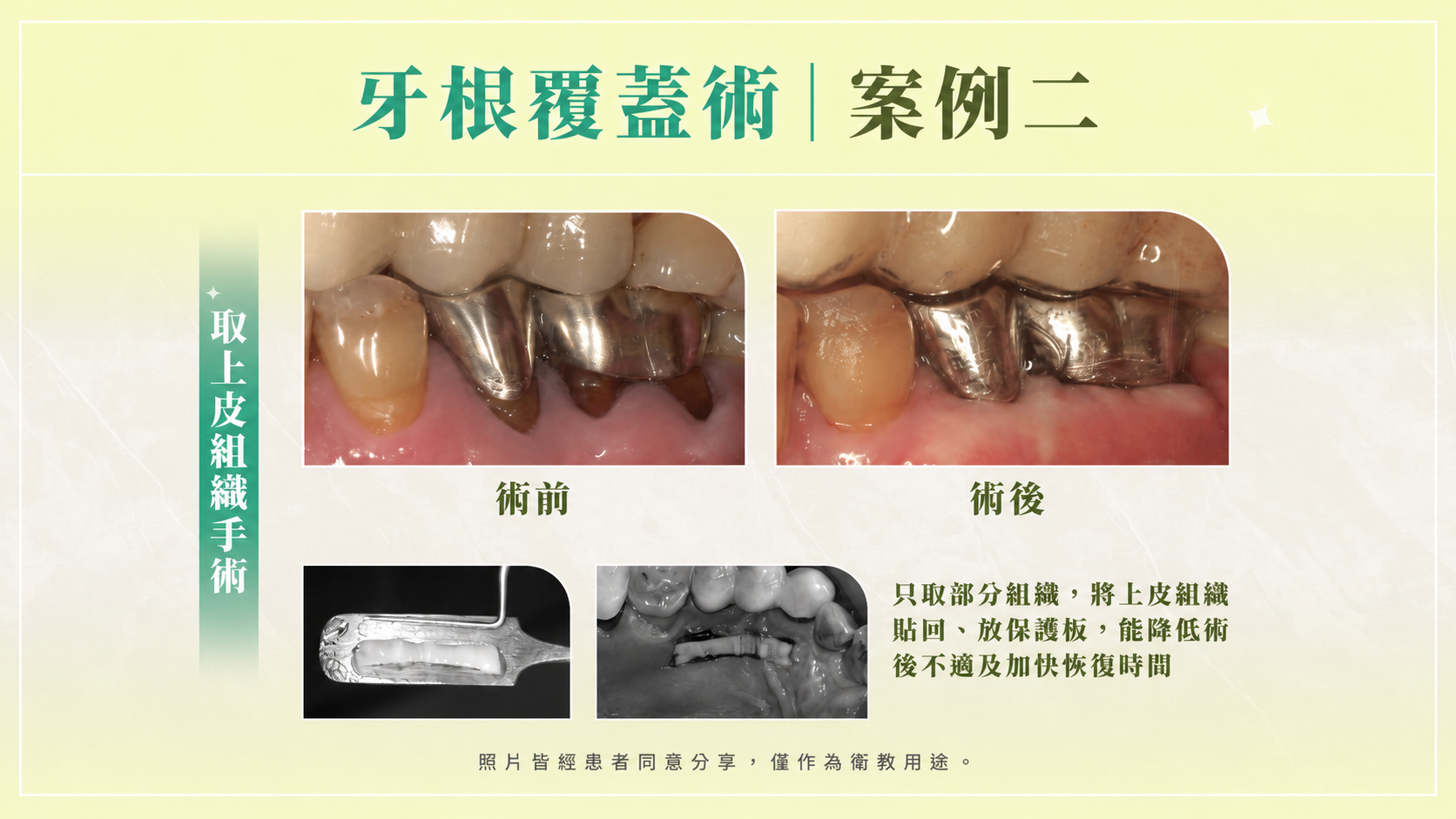 牙根覆蓋術案例治療前後對比