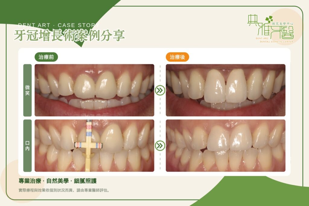 牙冠增長術案例，重做門牙假牙前調整牙齦高度，治療前後對比