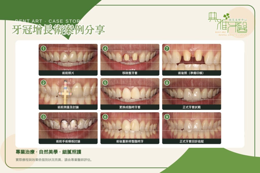 門牙假牙重做與牙冠增長術治療全流程九格圖：術前照片、術前測量及討論、術前手術模板討論、移除舊牙套、更換成臨時牙套、術後重新修整臨時牙、術後照（準備印模）、正式牙套試戴、正式牙套回診追蹤