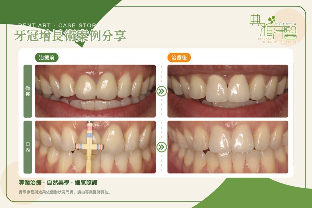 牙冠增長術案例，重做門牙假牙前調整牙齦高度，治療前後對比