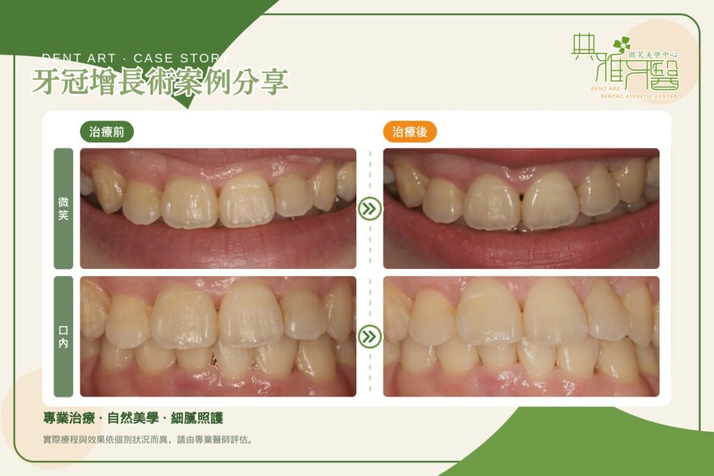 牙冠增長術案例|門牙看起來短、牙齦線不齊,調整牙齦高度找回牙齒比例 1 牙冠增長術案例,上顎門牙牙齦線調整前後對比(微笑與口內)