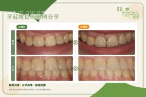牙冠增長術案例，上顎門牙牙齦線調整前後對比（微笑與口內）