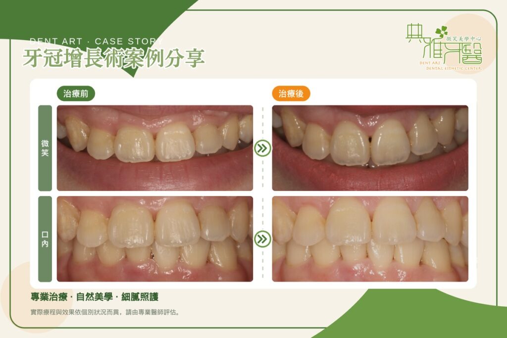 牙冠增長術案例，上顎門牙牙齦線調整前後對比（微笑與口內）