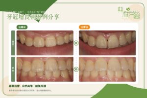牙冠增長術案例，上顎門牙牙齦線調整前後對比（微笑與口內）