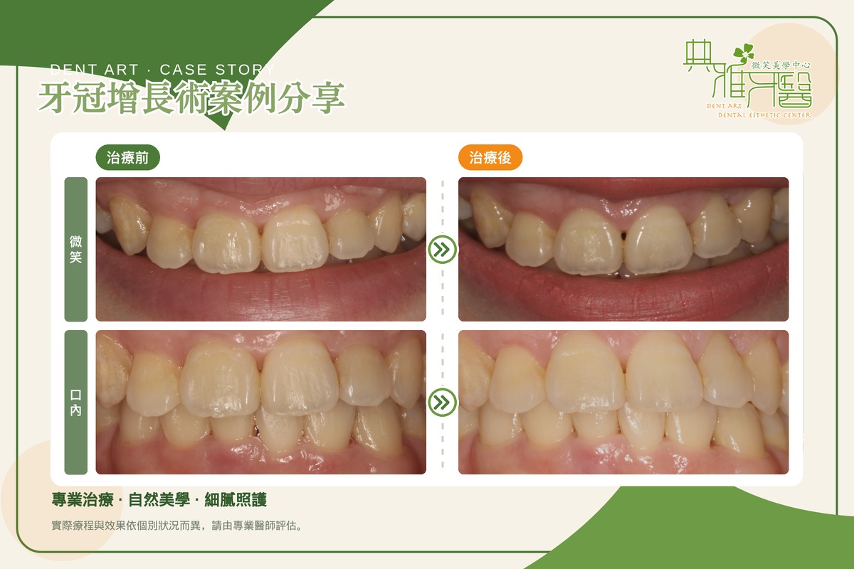 牙冠增長術案例，上顎門牙牙齦線調整前後對比（微笑與口內）