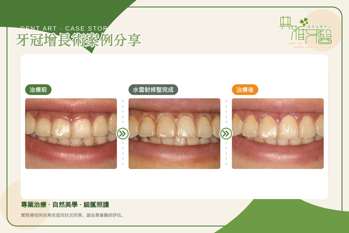 Read more about the article 水雷射牙冠增長術案例｜笑起來牙齦露太多，修整牙齦與骨頭調整笑容比例